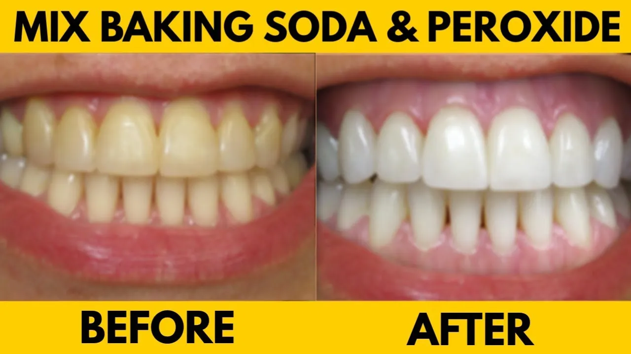 30011 hydrogen peroxide teeth whitening