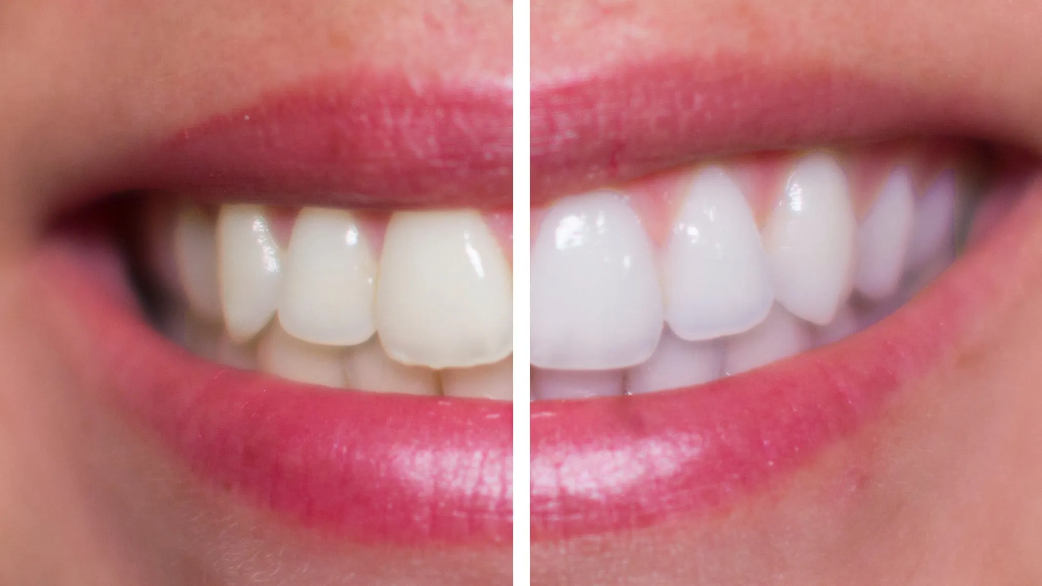 /img/30011-teeth-whitening-alternatives.webp