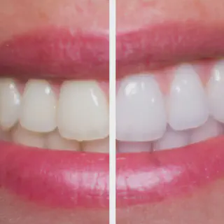 /img/30011-teeth-whitening-alternatives.webp
