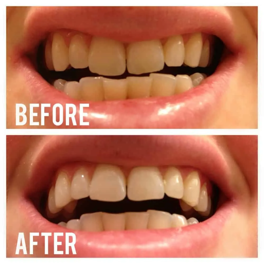 30011 teeth whitening hacks
