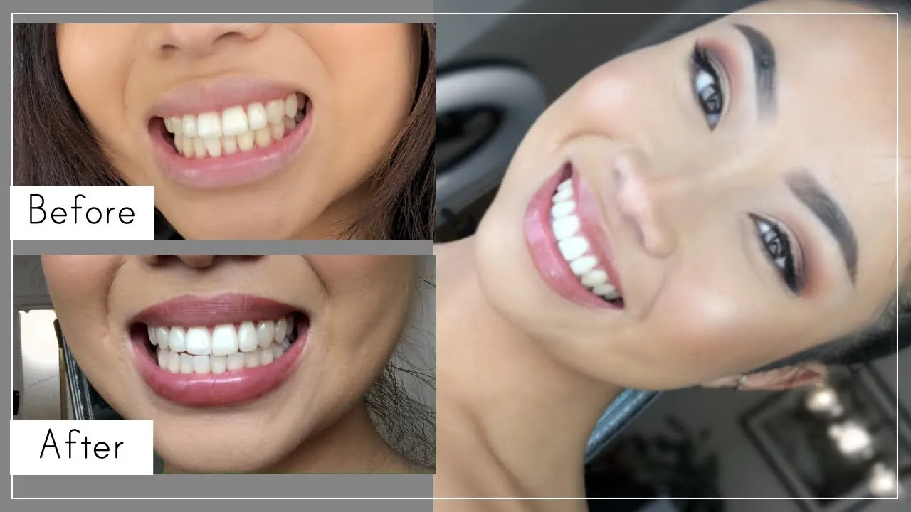 30011 teeth whitening peroxide overview
