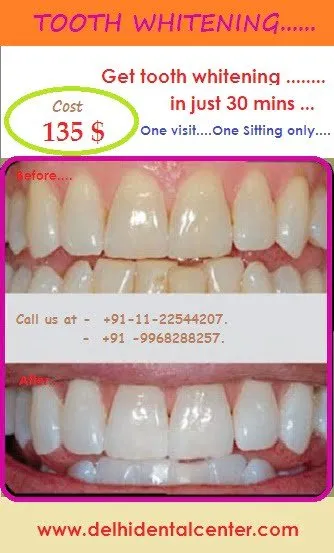 30013 teeth whitening maintenance