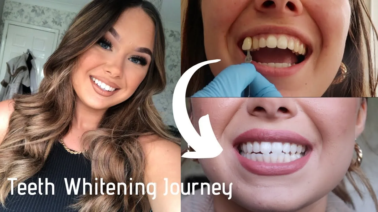 /img/30015-affordable-teeth-whitening.webp
