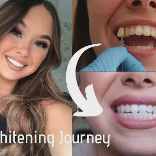 /img/30015-affordable-teeth-whitening.webp