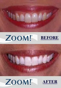 30015 teeth whitening results