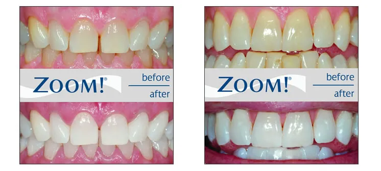 30015 zoom whitening treatment