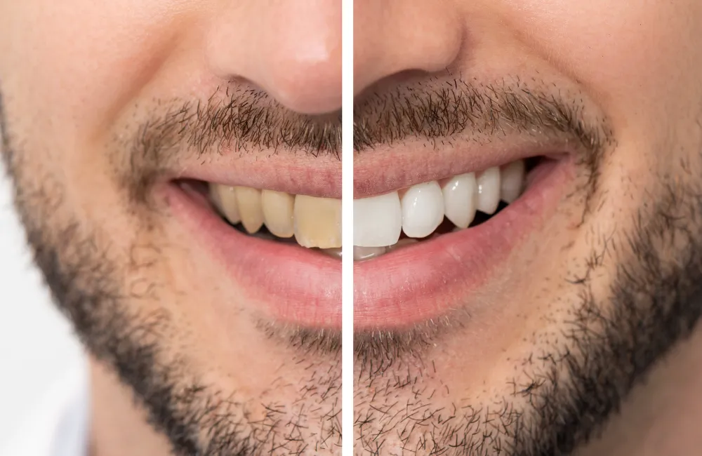 30017 in office whitening