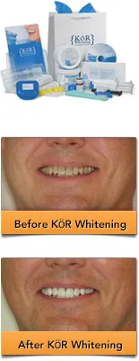 /img/30018-post-whitening-care.webp