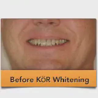 /img/30018-post-whitening-care.webp