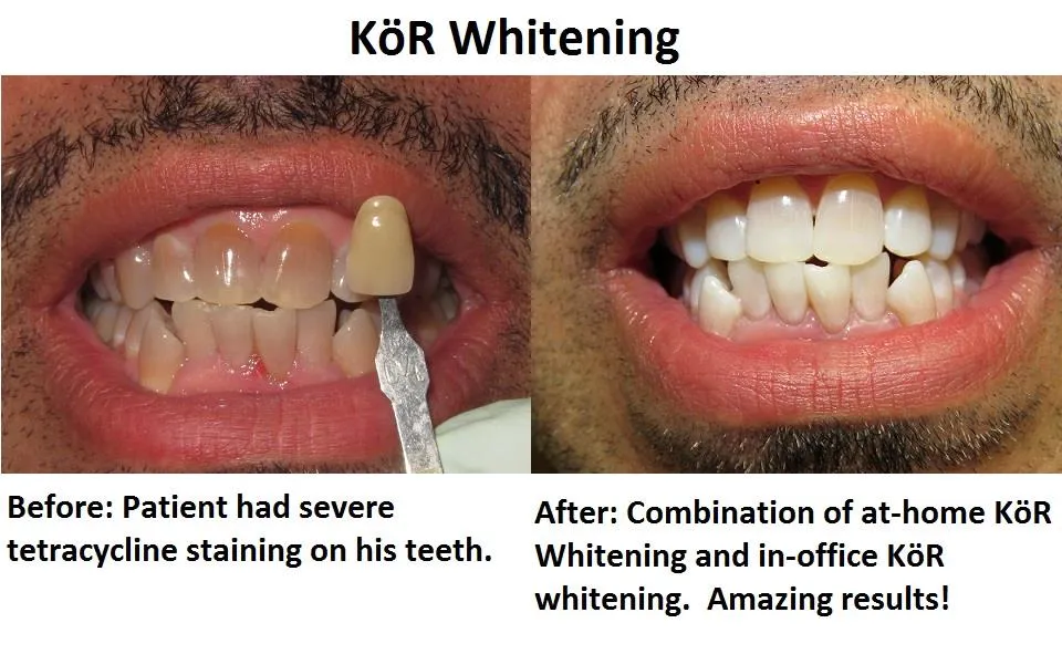 30018 teeth whitening comparison