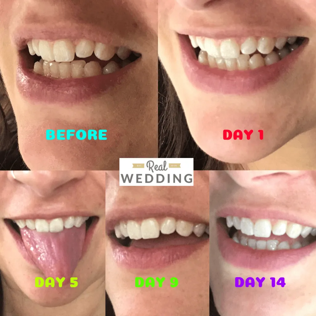 30019 at home teeth whitening kit