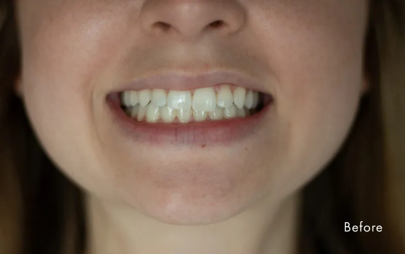 30019 dental cleaning before wedding