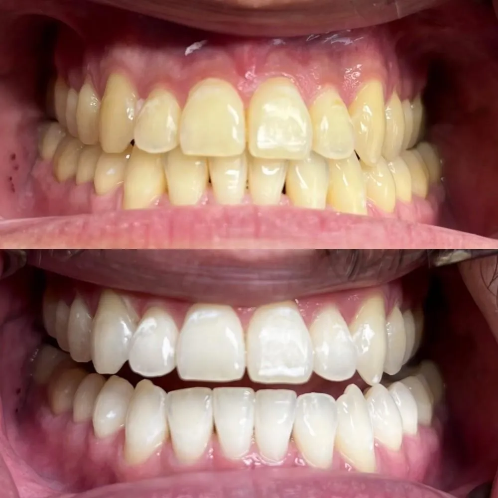 30020 teeth whitening consultation