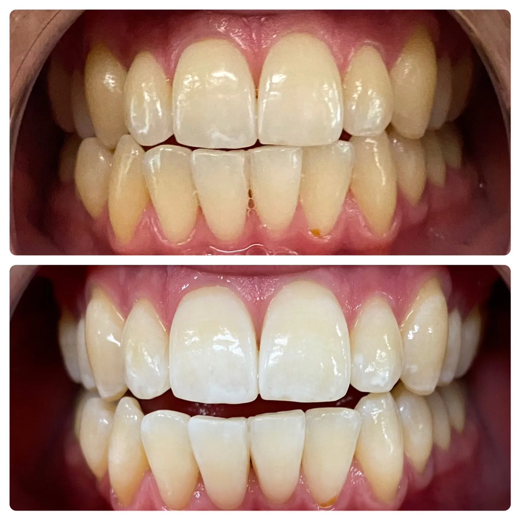 30023 laser teeth whitening