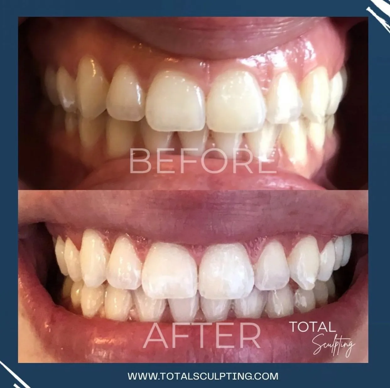 30024 teeth whitening elk grove 1