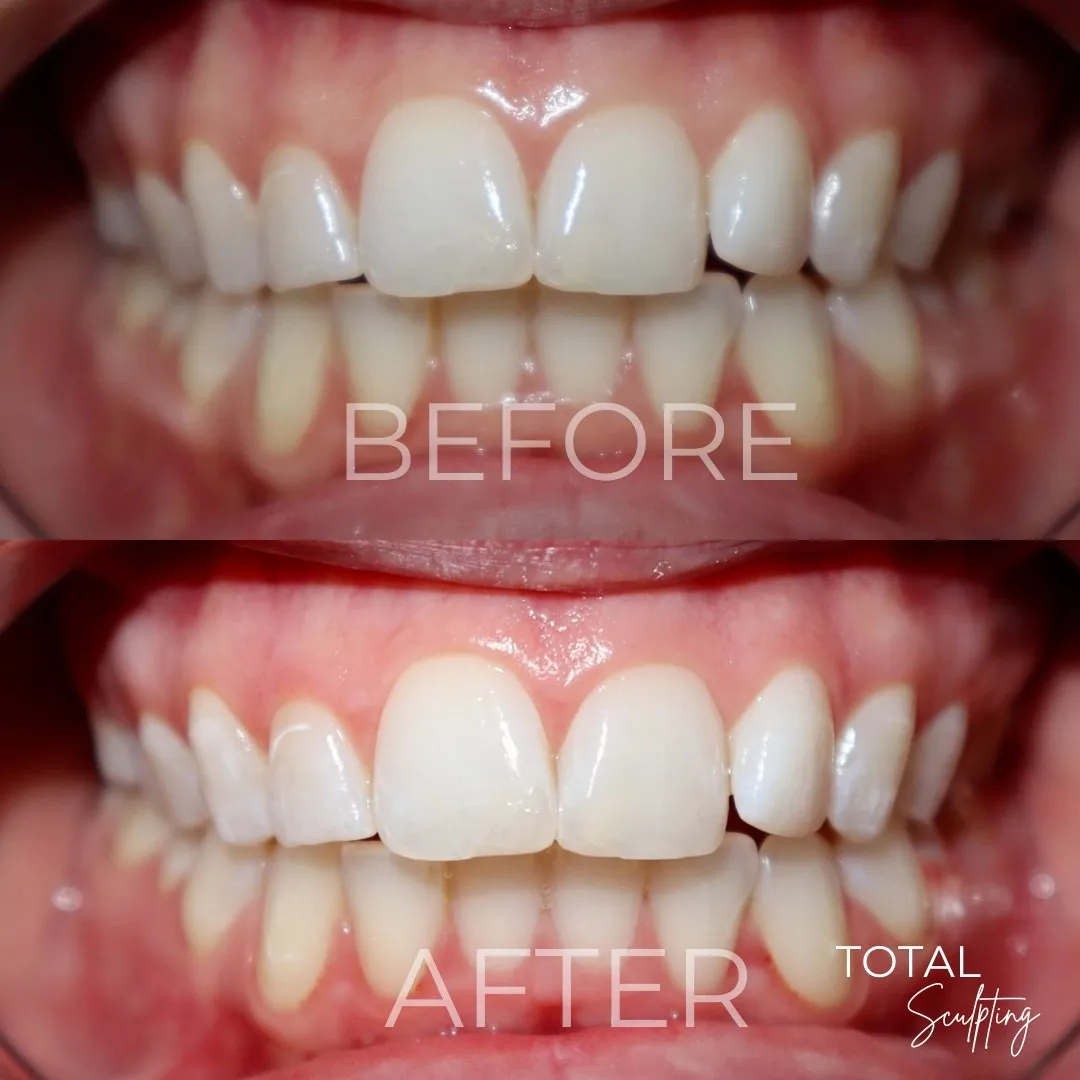 30024 teeth whitening elk grove 2