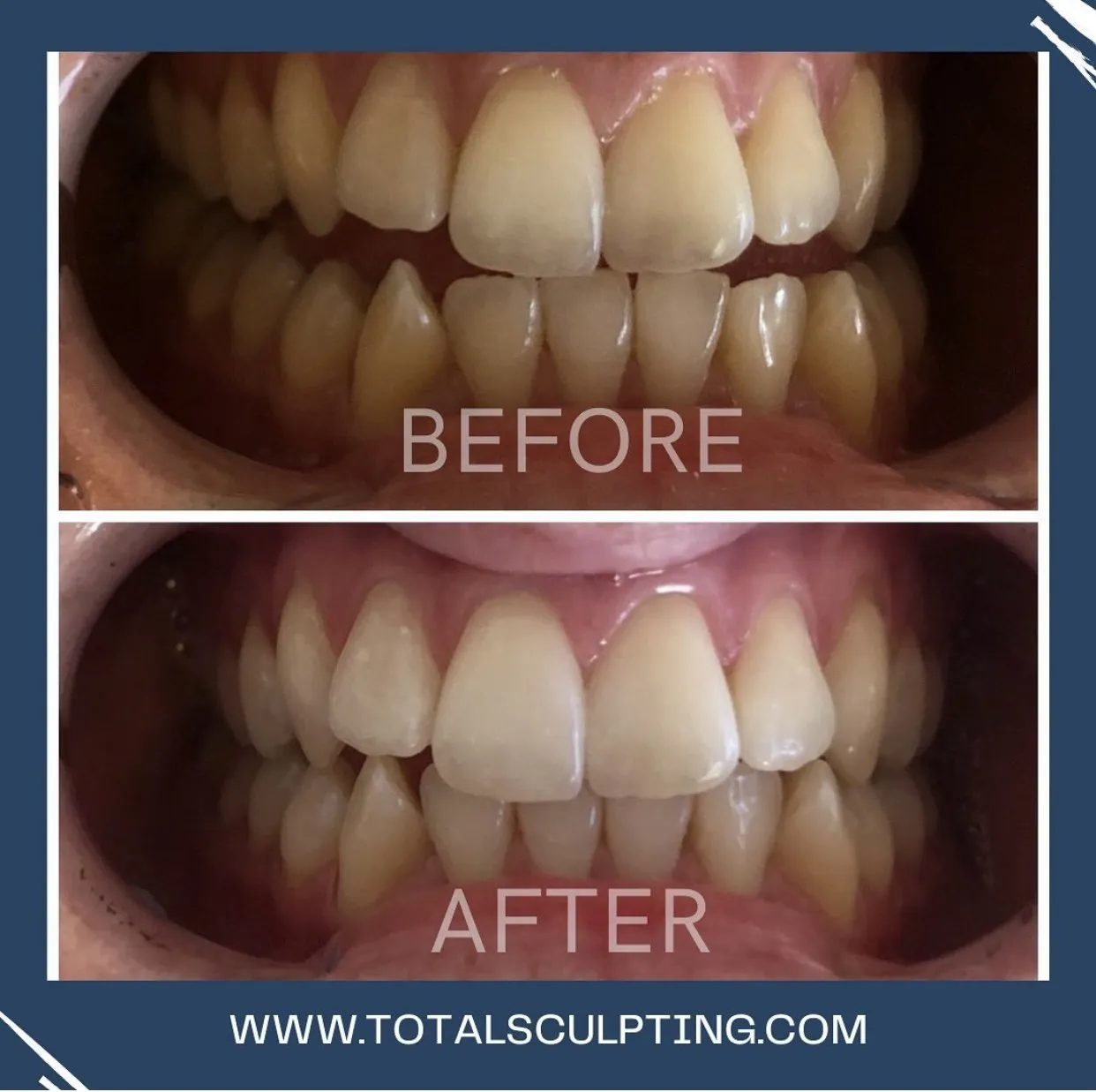 30024 teeth whitening elk grove 3