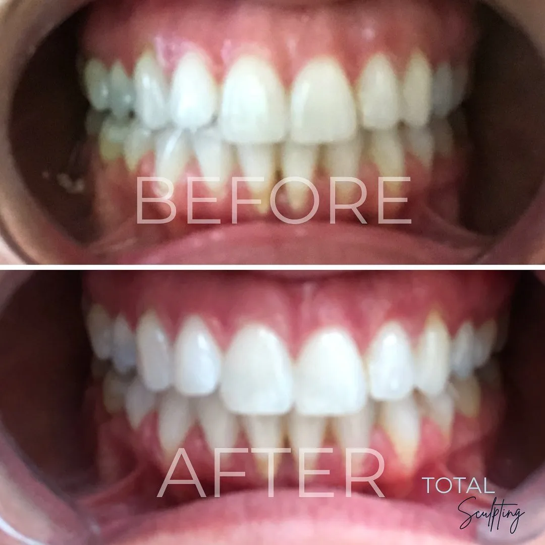 30024 teeth whitening elk grove 5