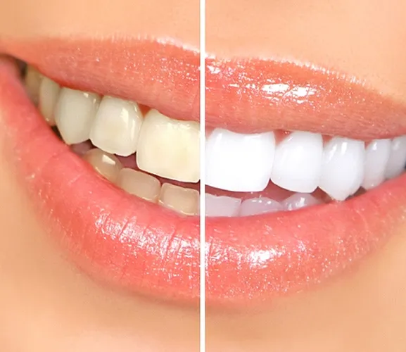30028 package teeth whitening