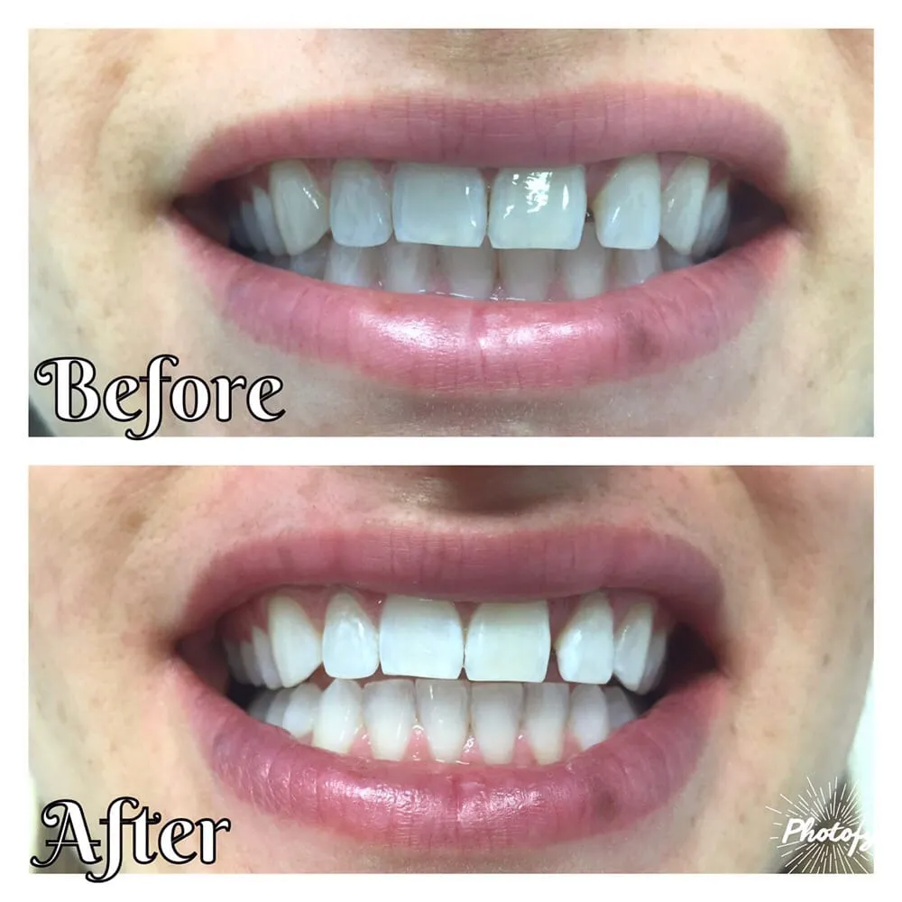 30028 premium teeth whitening