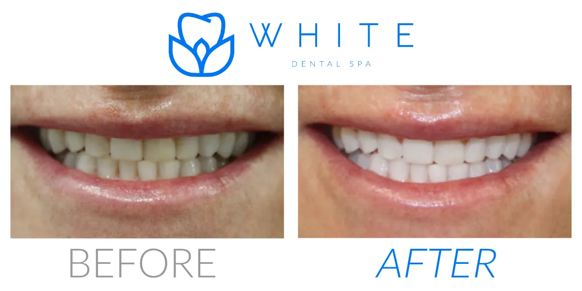 30028 reputation reviews teeth whitening