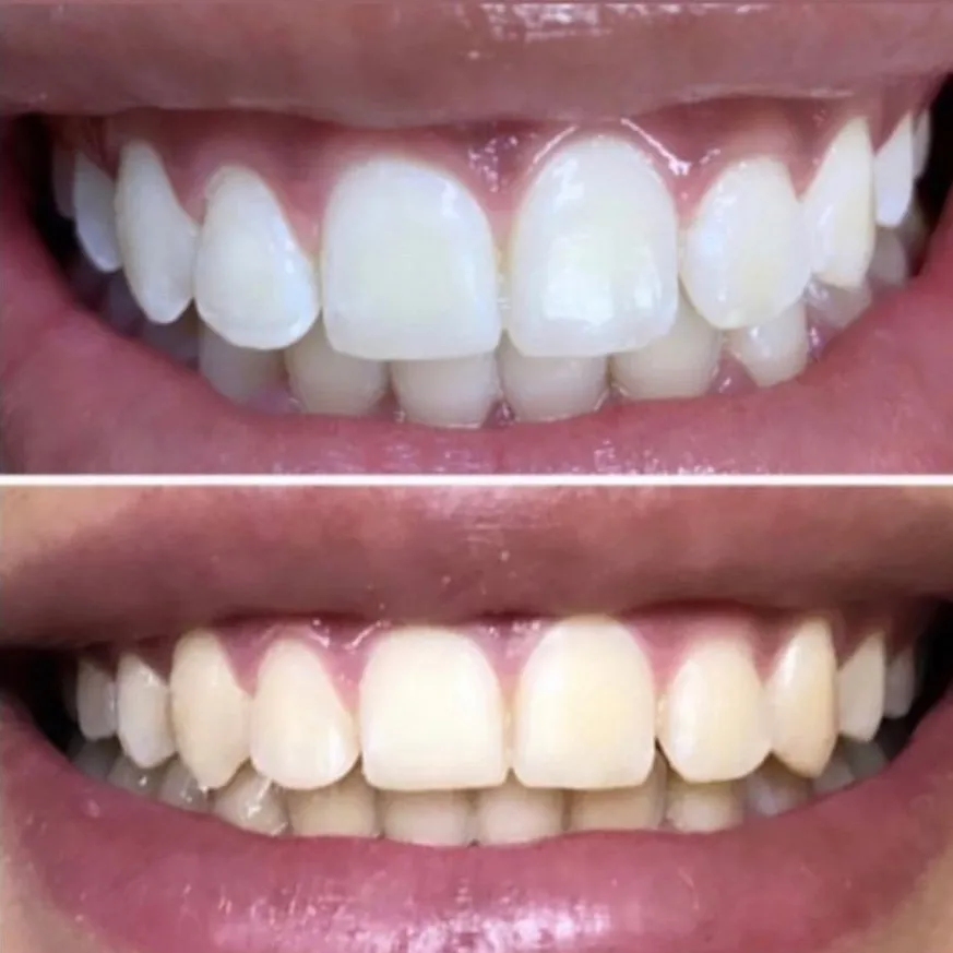 30028 special teeth whitening