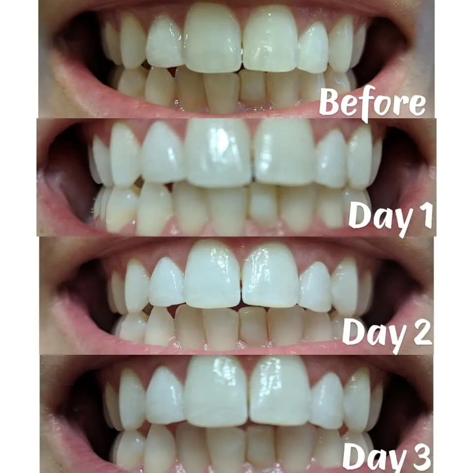 /img/30031-before-after-teeth-whitening.webp