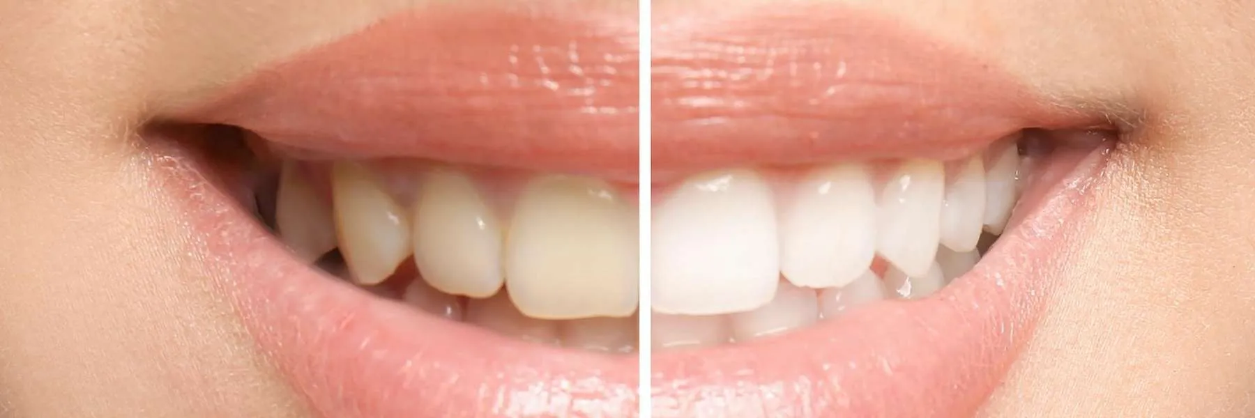 30032 whitening process 5