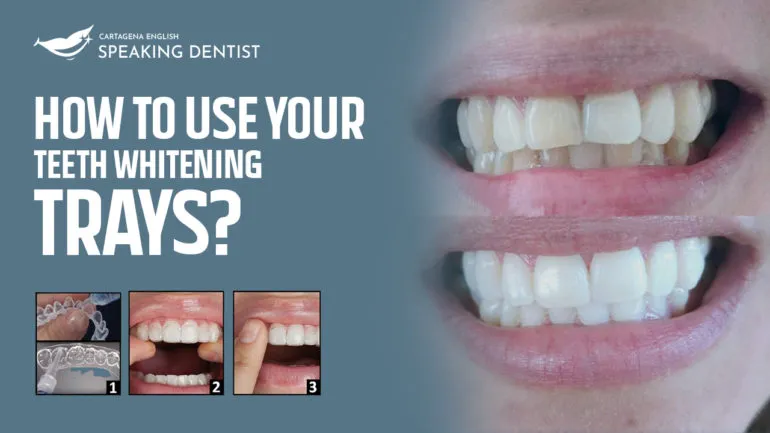 30036 custom whitening trays