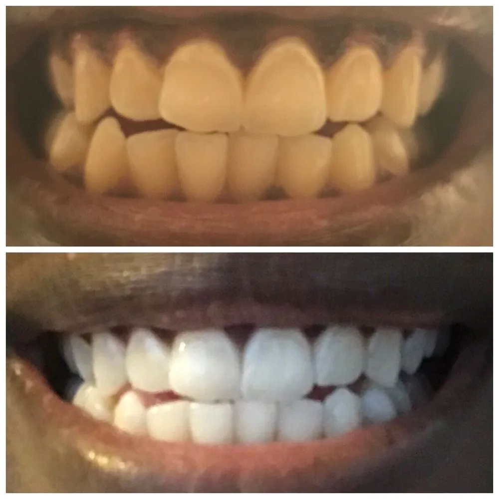 30039 teeth whitening birmingham al 2