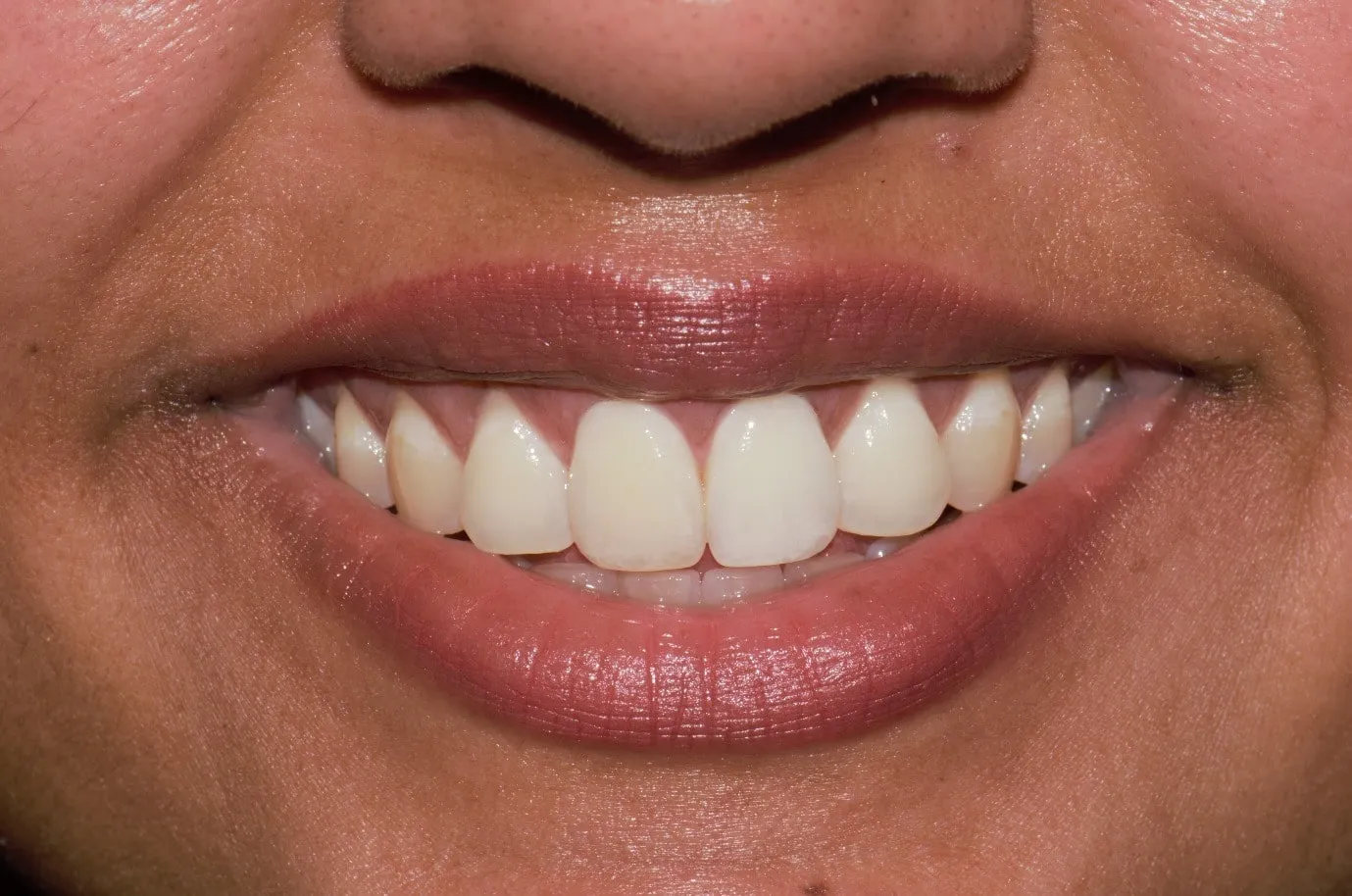 /img/30039-teeth-whitening-birmingham-al-7.webp