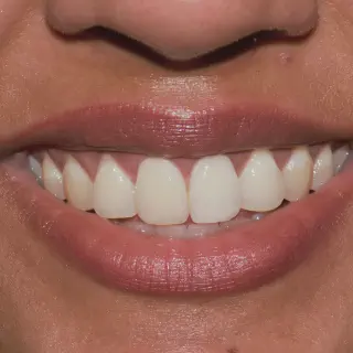 /img/30039-teeth-whitening-birmingham-al-7.webp