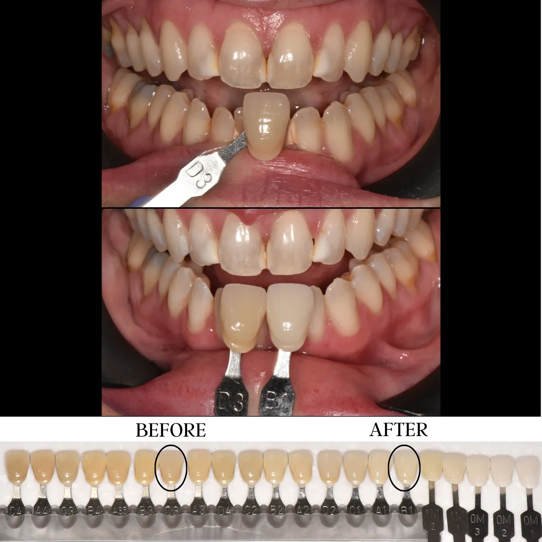 30040 sioux falls teeth whitening professional