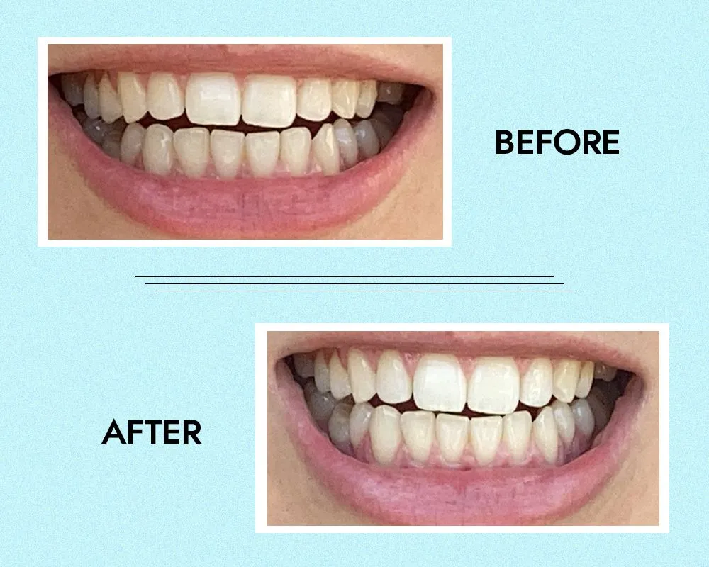 30041 hismile kit components