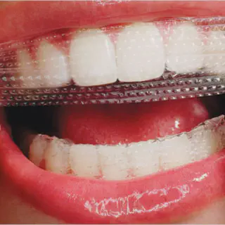 /img/30047-alternative-teeth-whitening.webp
