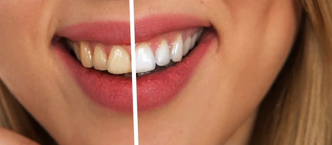 30057 teeth whitening effects image1