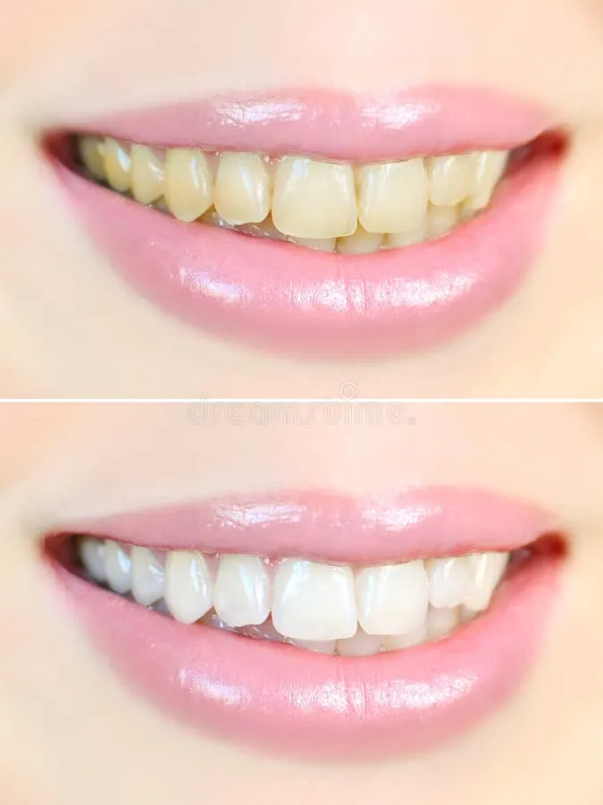30057 teeth whitening effects image2