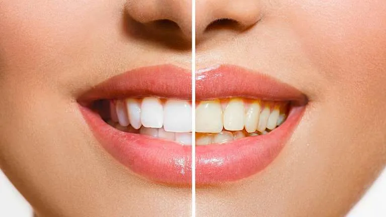 30057 teeth whitening effects image3