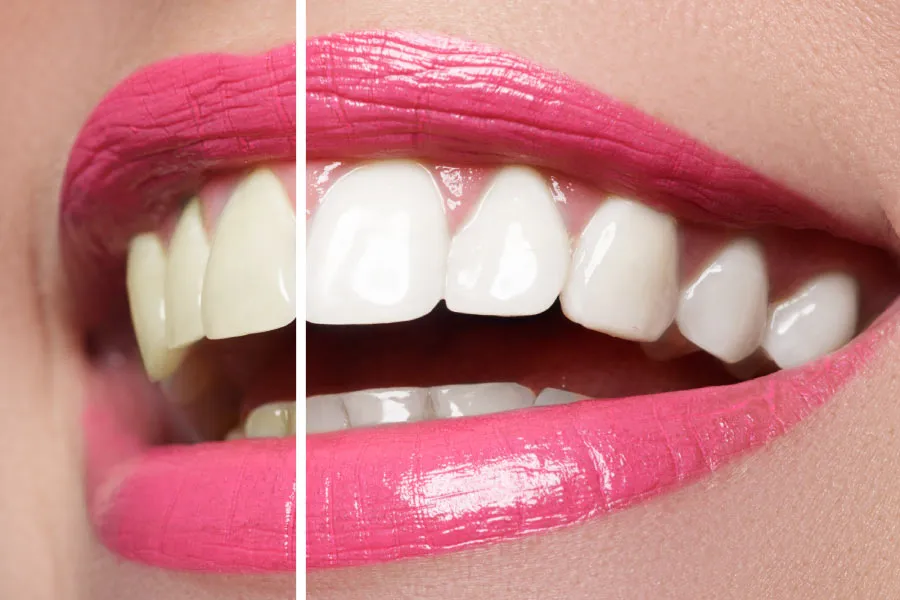 30057 teeth whitening effects image4