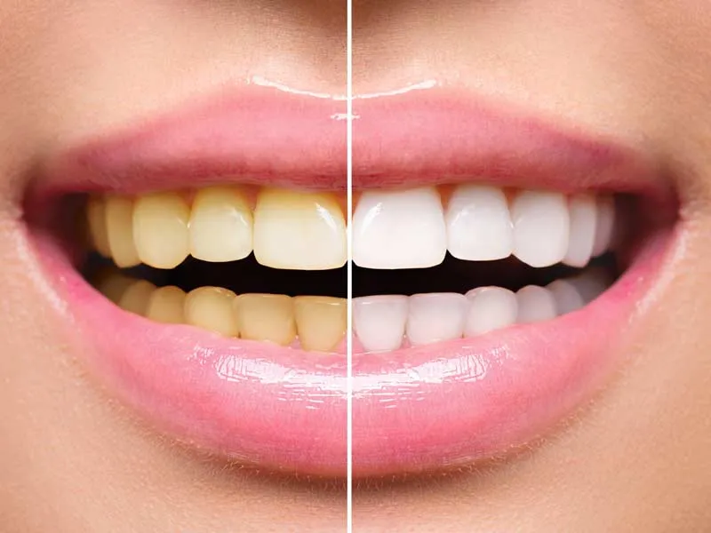 /img/30057-teeth-whitening-effects-image7.webp