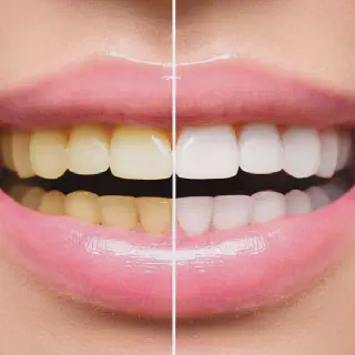 /img/30057-teeth-whitening-effects-image7.webp