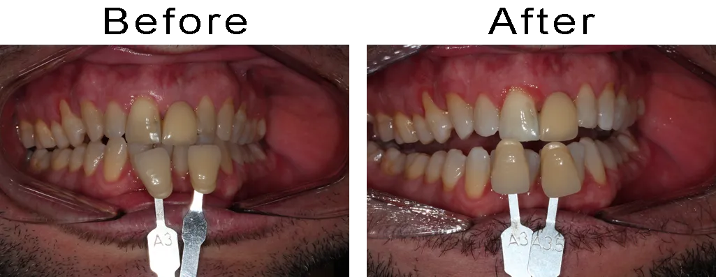 30063 in office whitening