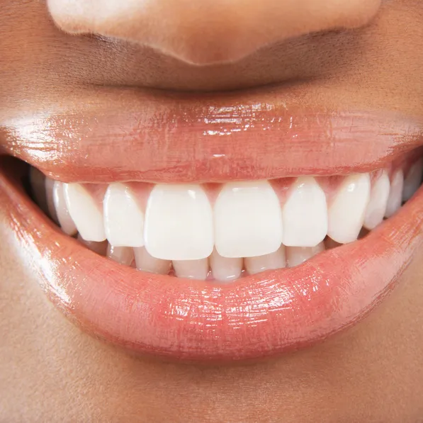 30063 teeth whitening options