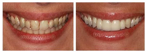 30063 whitening strips