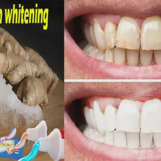/img/30065-salt-teeth-whitening-image7.webp