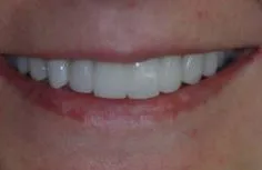 30068 teeth whitening erie pa image3