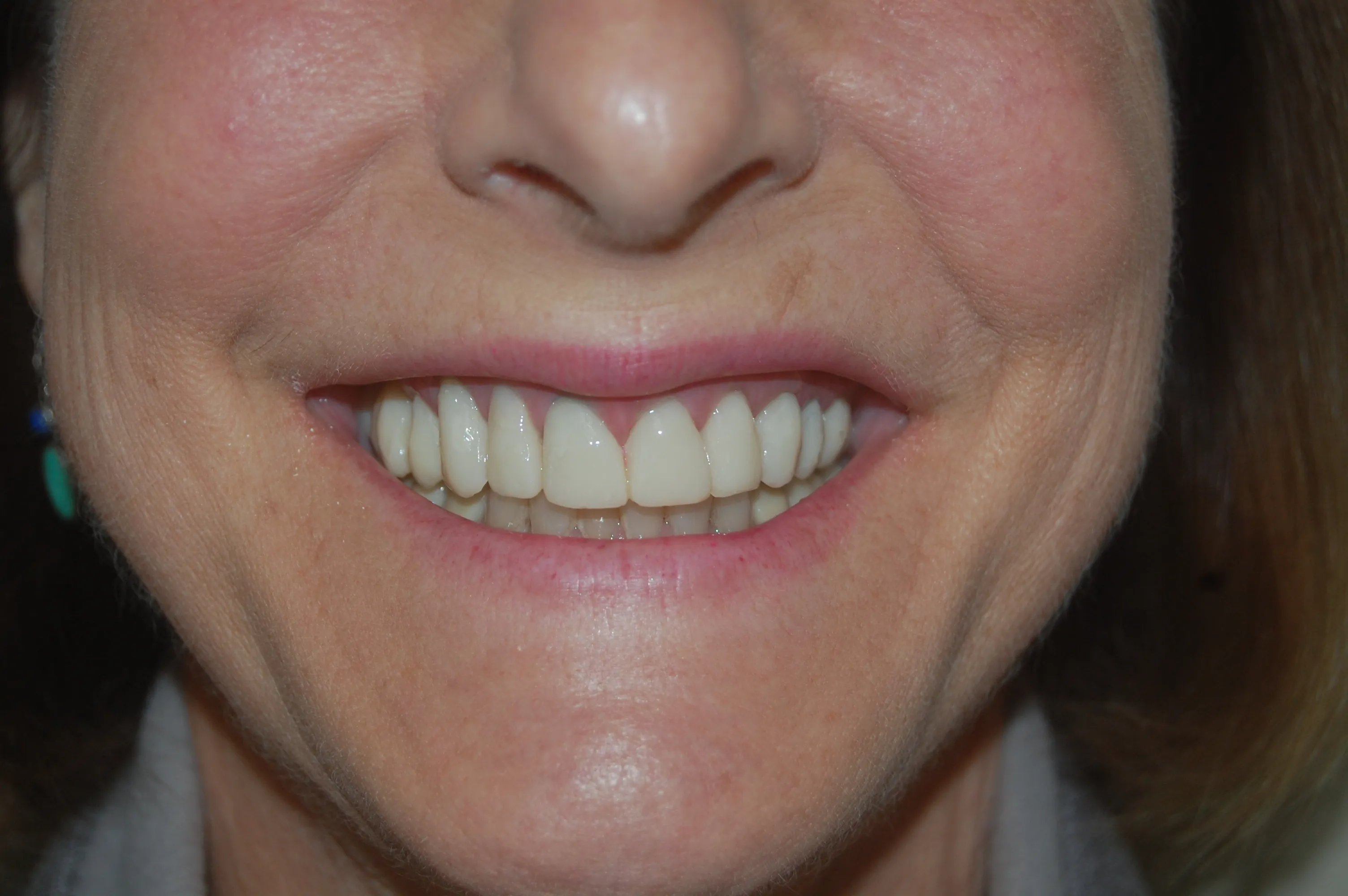30068 teeth whitening erie pa image4