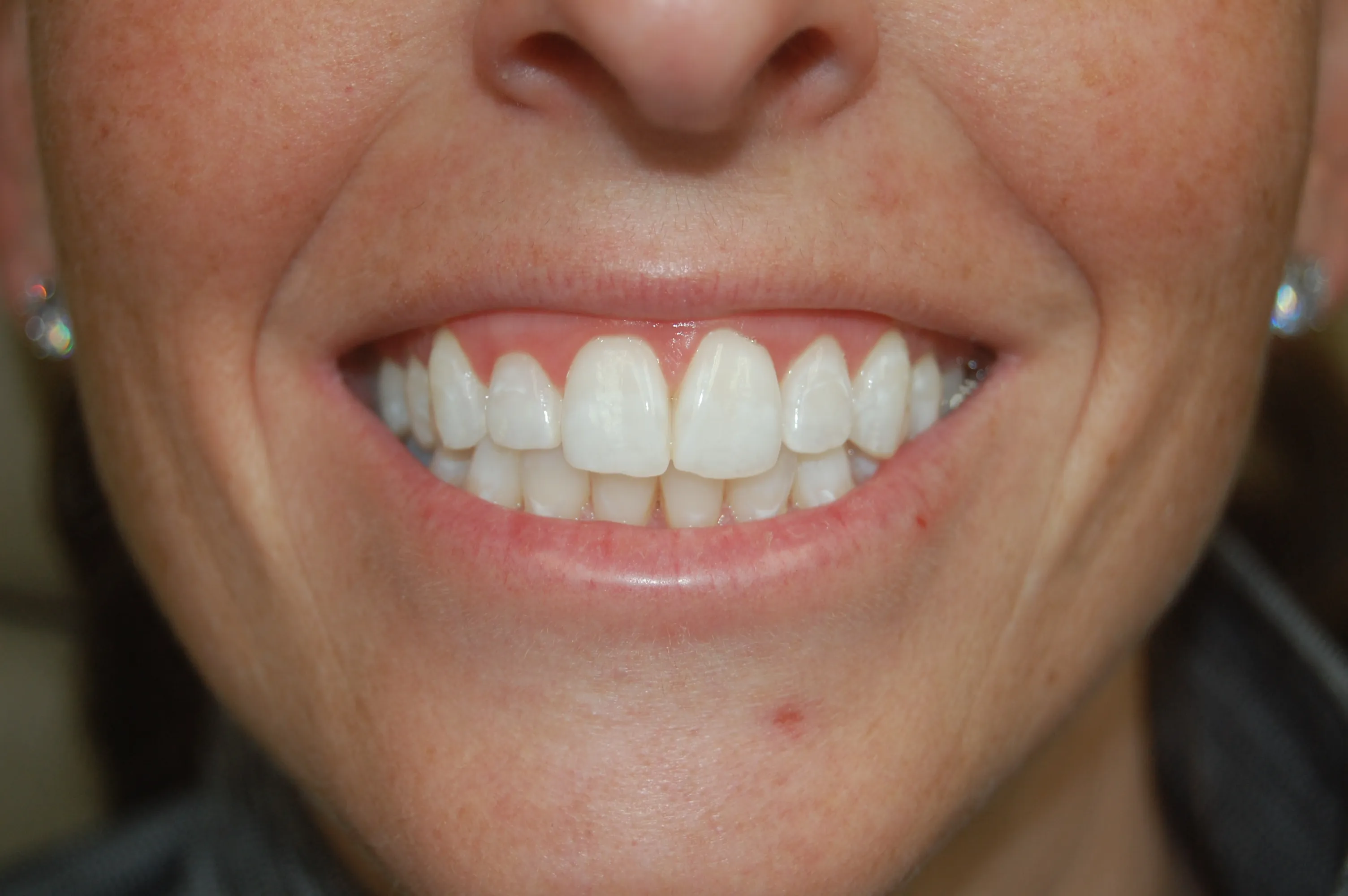 30068 teeth whitening erie pa image5