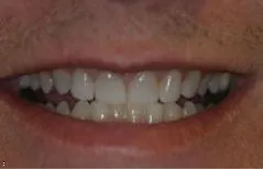 30068 teeth whitening erie pa image6