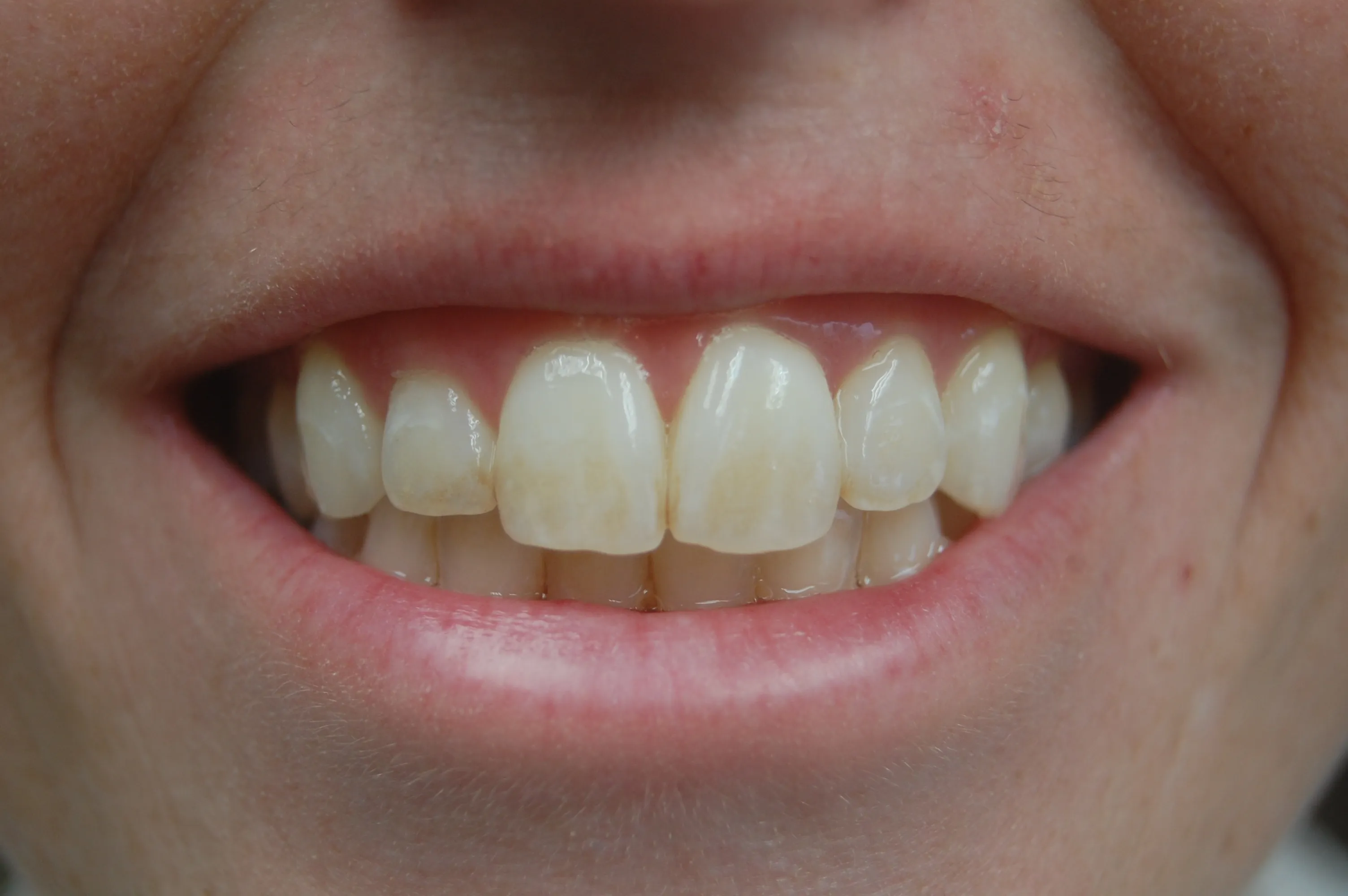 /img/30068-teeth-whitening-erie-pa-image7.webp